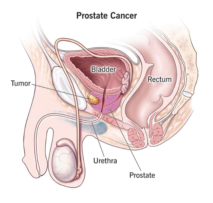 Prostate Cancer