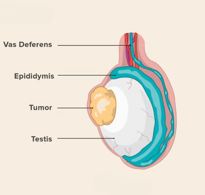Testicular Cancer
