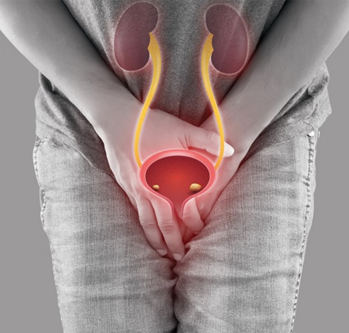 What Are Urinary Stones