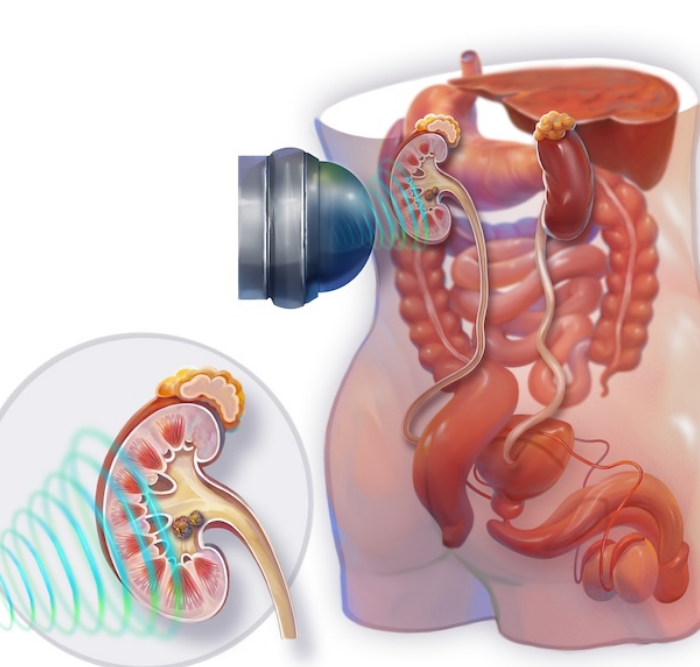 ESWL treatment in Ahmedabad