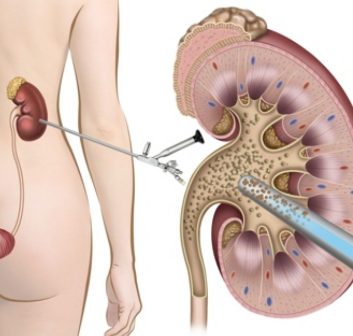 Advanced Kidney Stone Removal with PCNL