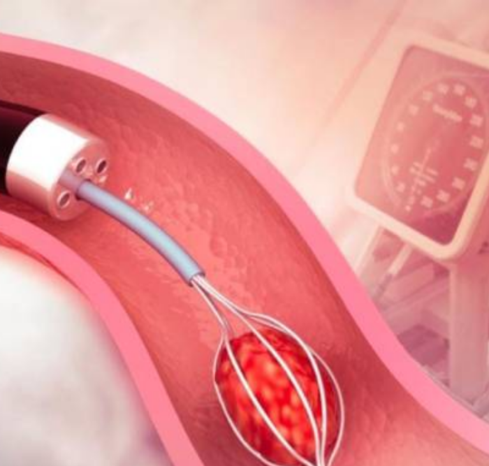 Retrograde Intrarenal Surgery (RIRS) in Ahmedabad