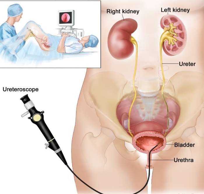 Ureteroscopy (URS) Surgery in Ahmedabad