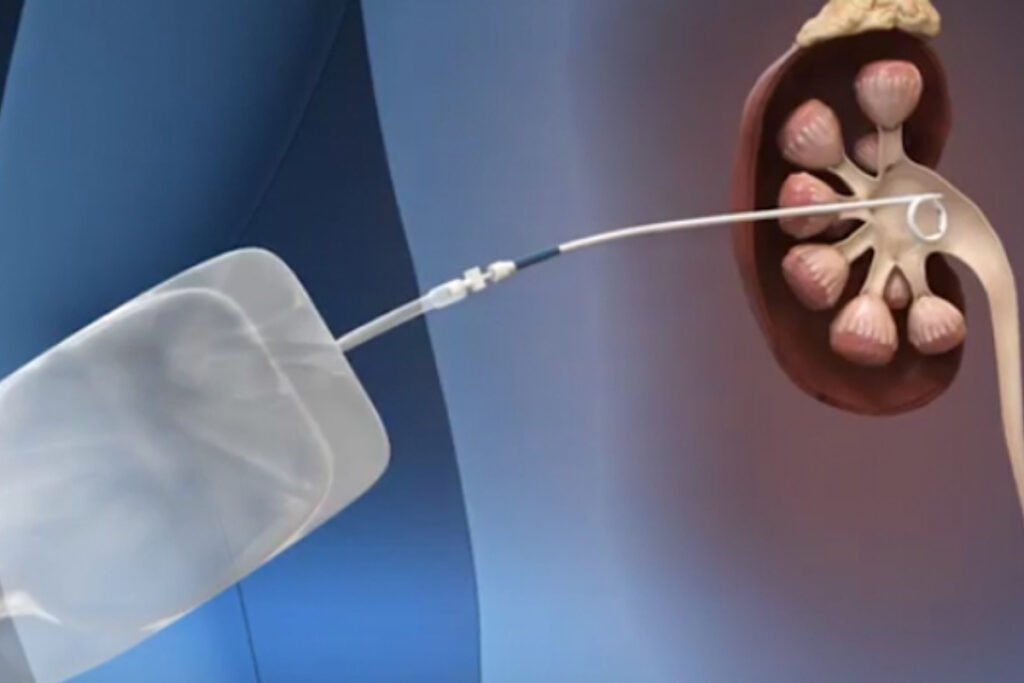 Percutaneous Nephrolithotomy (PCNL)​