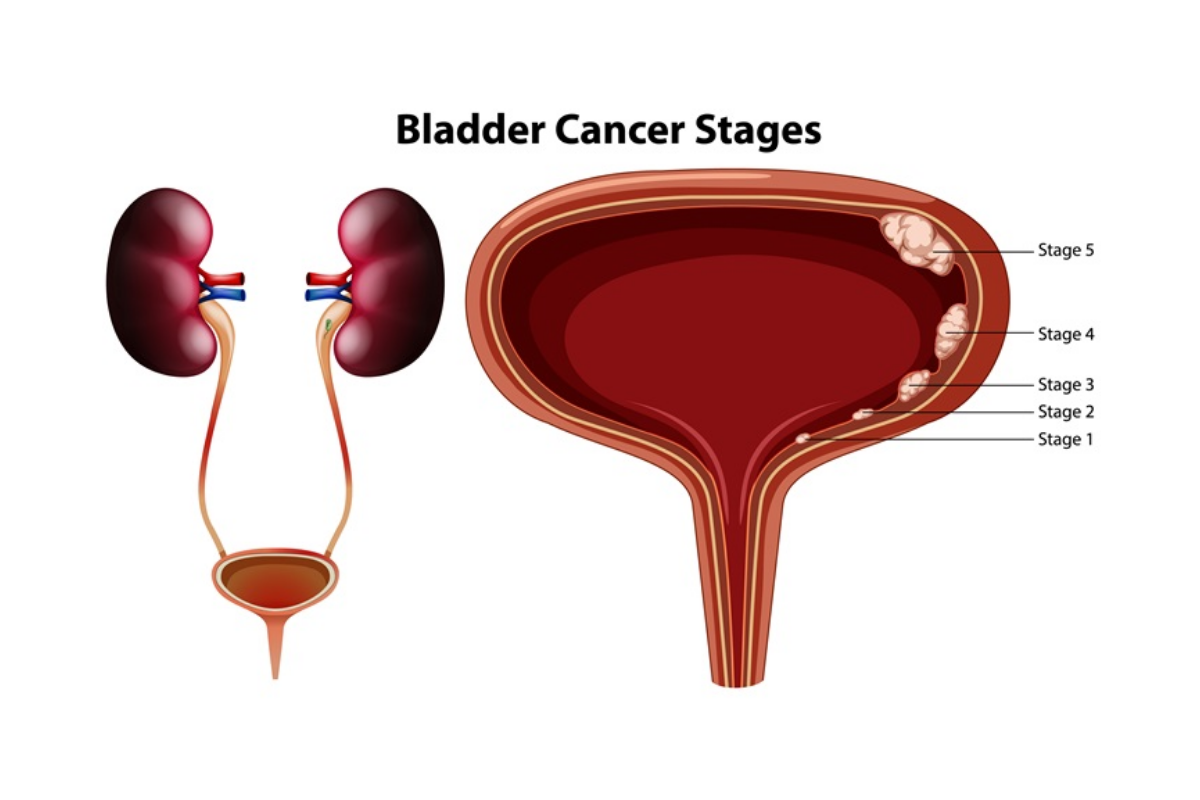 Bladder Cancer