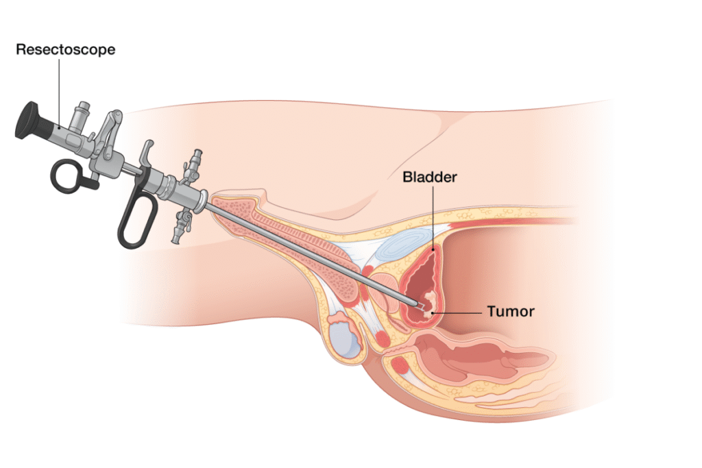 Transurethral Resection of Bladder Tumor (TURBT)