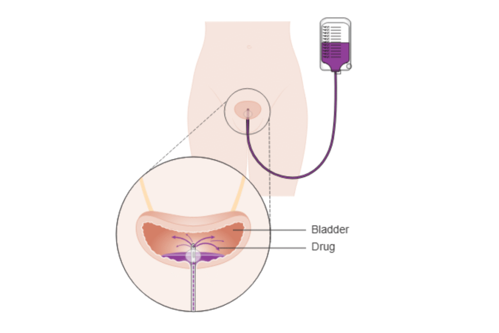 Intravesical Therapy (BCG or Chemotherapy Instillation)