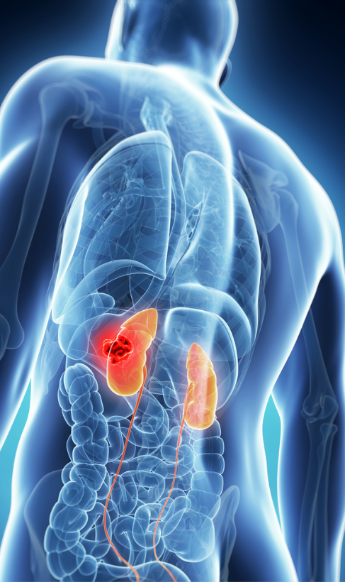 Kidney Cancer Treatment Ahmedabad​