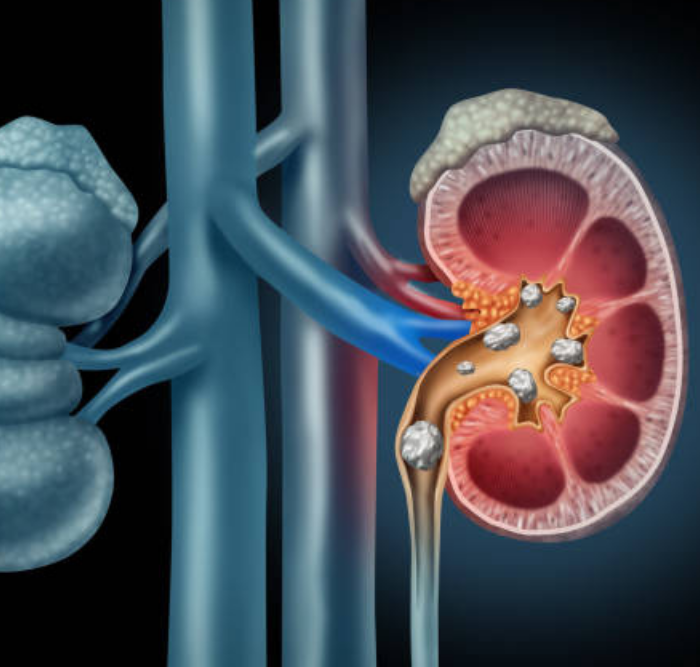 Kidney Stone