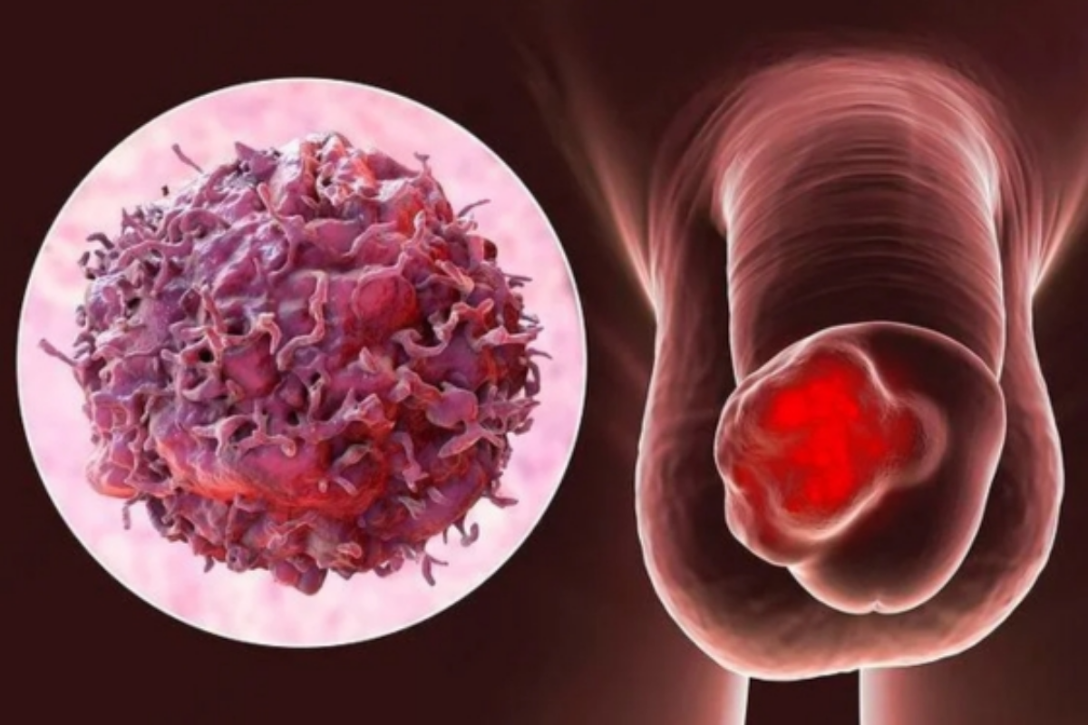 Penile Cancer Treatment in Ahmedabad