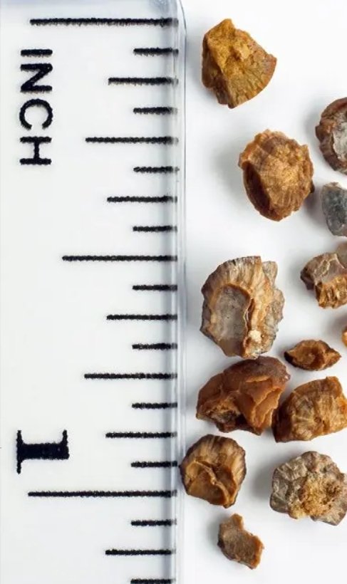 Kidney Stone Treatment