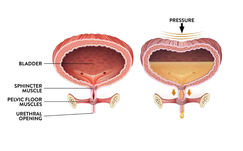 Stress Urinary Incontinence Treatment