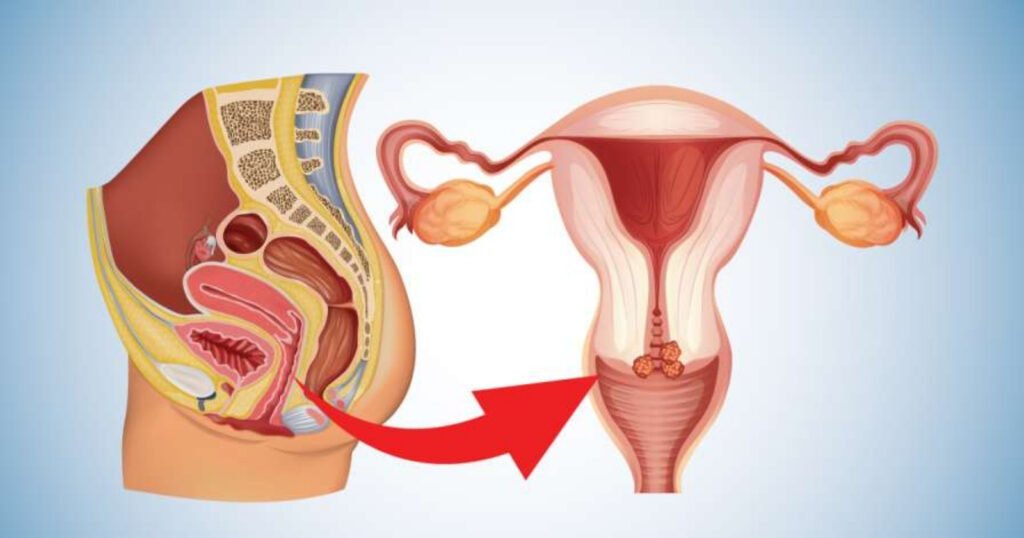 Cervical Cancer Screening and Treatment