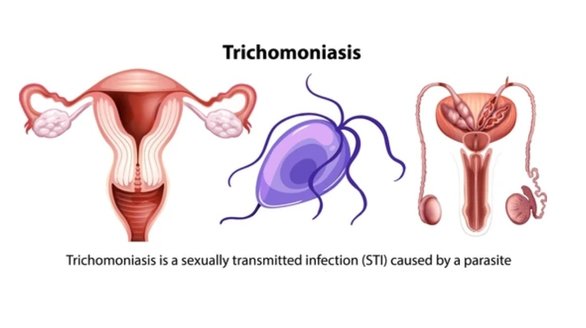 Trichomoniasis