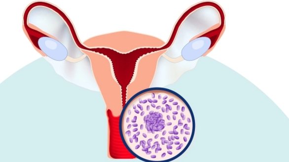 Mixed or Recurrent Infections