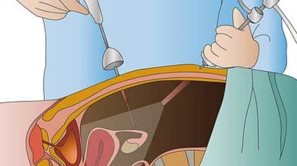 Permanent Contraception