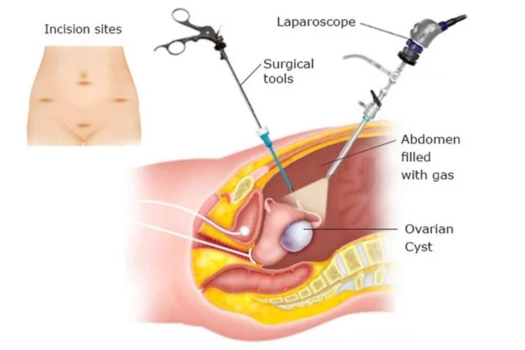 Laparoscopic Ovarian Cyst Removal