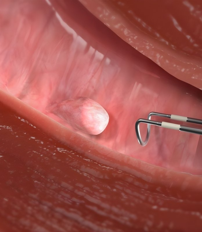 Hysteroscopic Polyp Removal