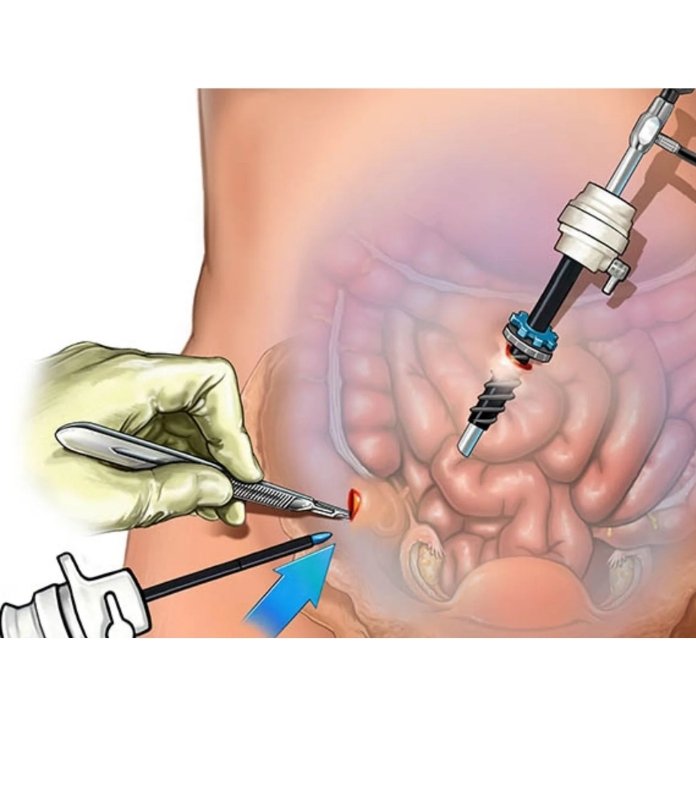 Endometriosis Surgery