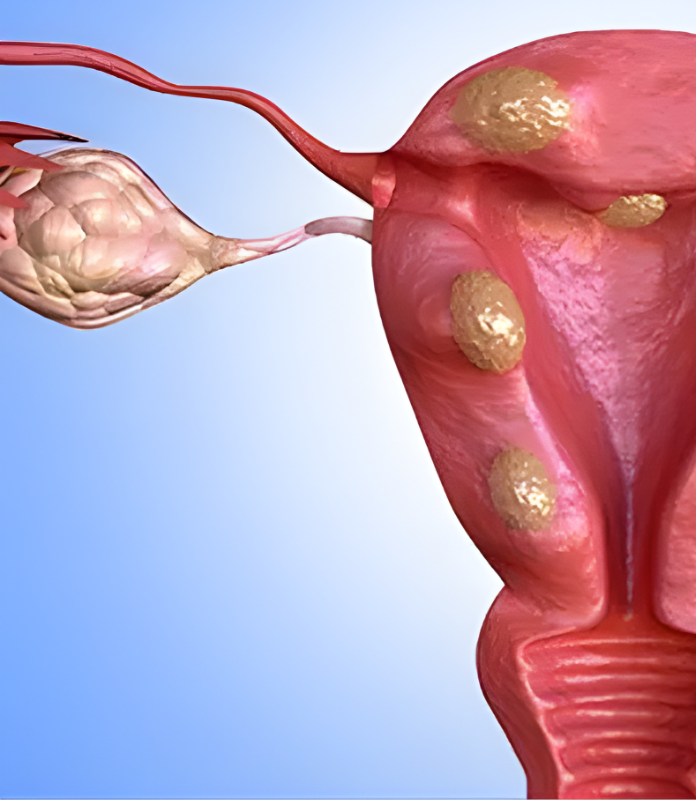 Myomectomy (FIbroid Removal)