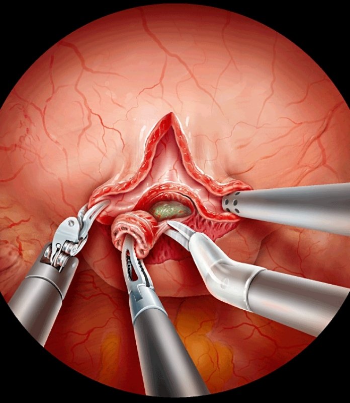 Fistula Repair Surgery