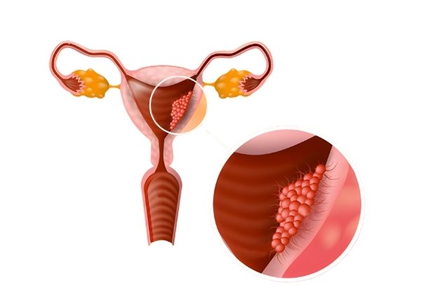 Uterine (Endometrial) Cancer Treatment