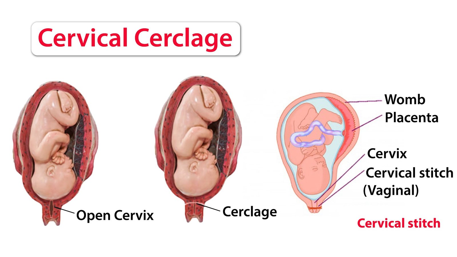 Cervical Cerclage