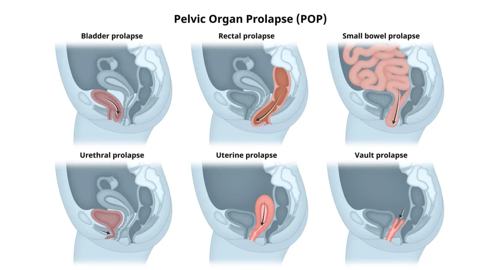 Pelvic Organ Prolapse Surgery