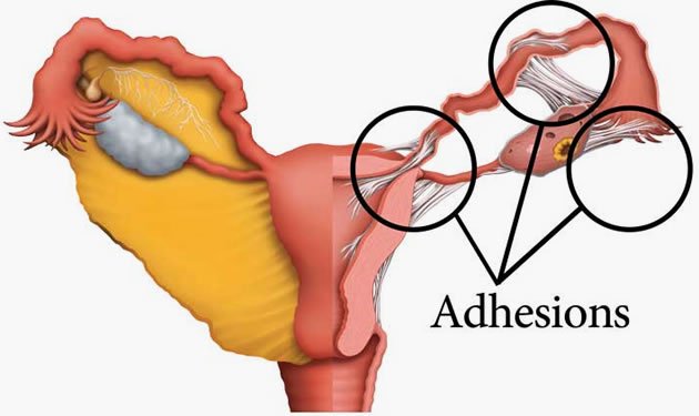 Adhesiolysis (Scar Tissue Removal)