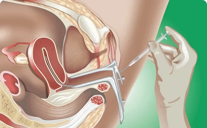 IUI (Intrauterine Insemination)