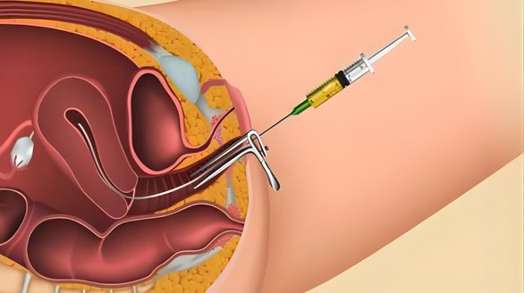 Timed Insemination Procedure
